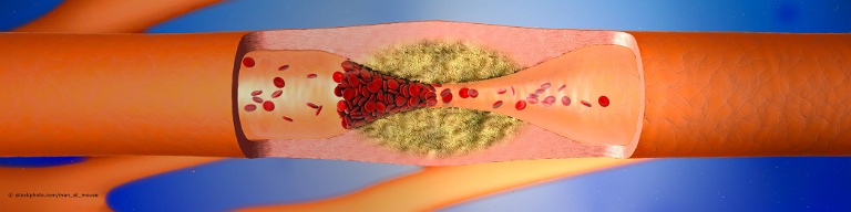 Verengte und entzündete Halsschlagader.