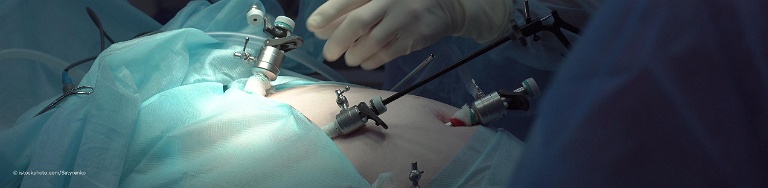 Arzt für Viszeralchirurgie schiebt bei der Bauchspiegelung ein Laparoskop durch einen Trokar in den durch eingeleitetes Gas aufgeblähten Bauch des Patienten.