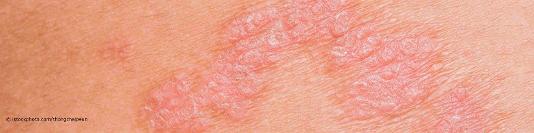 Psoriasis, auch Schuppenflechte genannt, führt zu einer roten und schuppigen Hautentzündung.