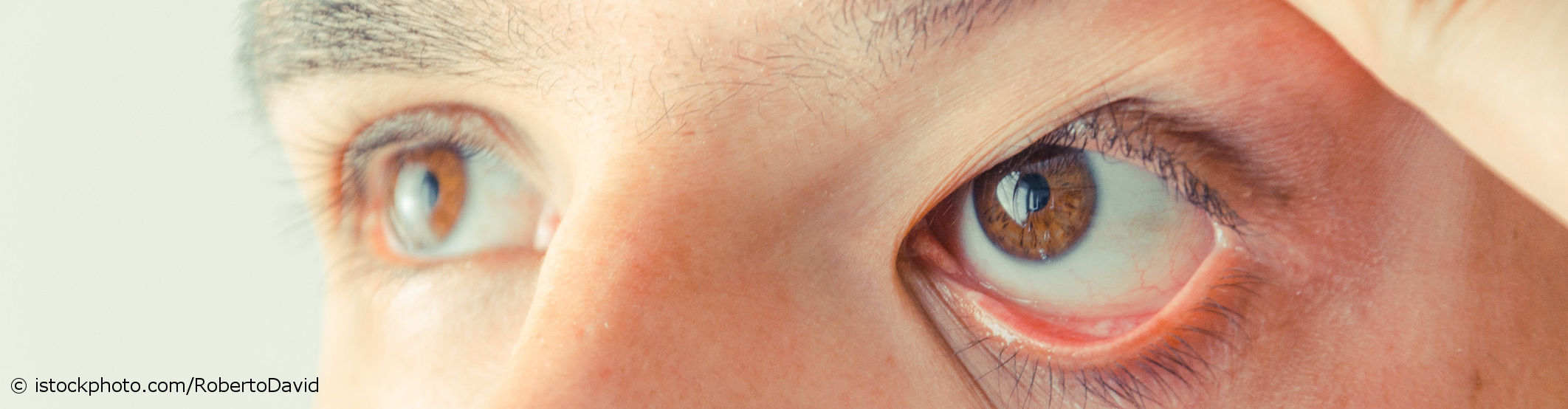 Trockene Augen Symptome