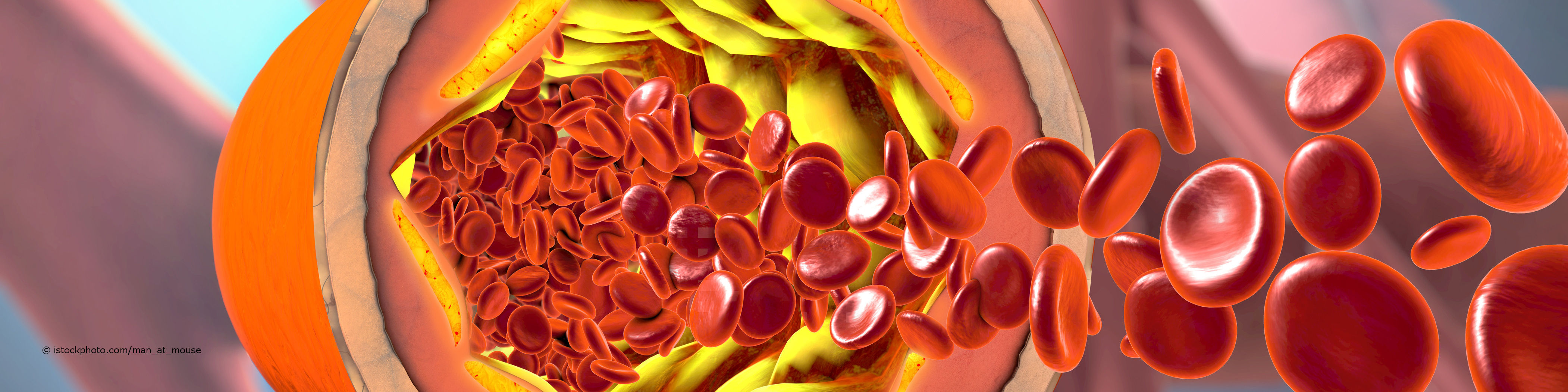 Blutplättchen versuchen ein durch Fetteinlagerung entzündetes Blutgefäß zu reparieren