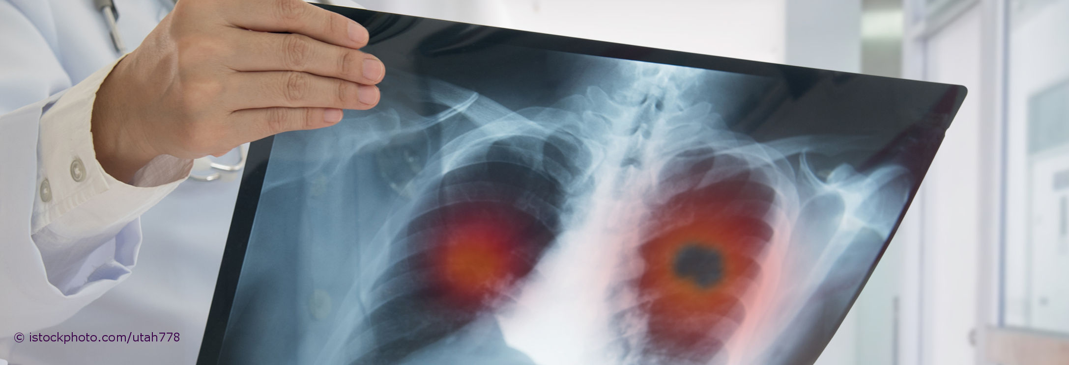 Ein Facharzt für Innere Medizin und Pneumologie betrachtet das Röntgenbild einer Lunge mit Tumor.