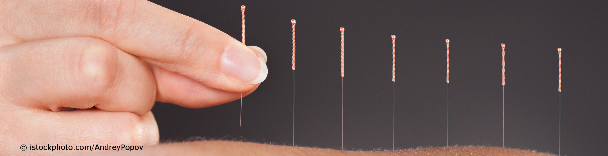 Auf docinsider registrierter Arzt mit Weiterbildung in Akupunktur setzt sieben Akupunkturnadeln in die Haut eines Patienten.