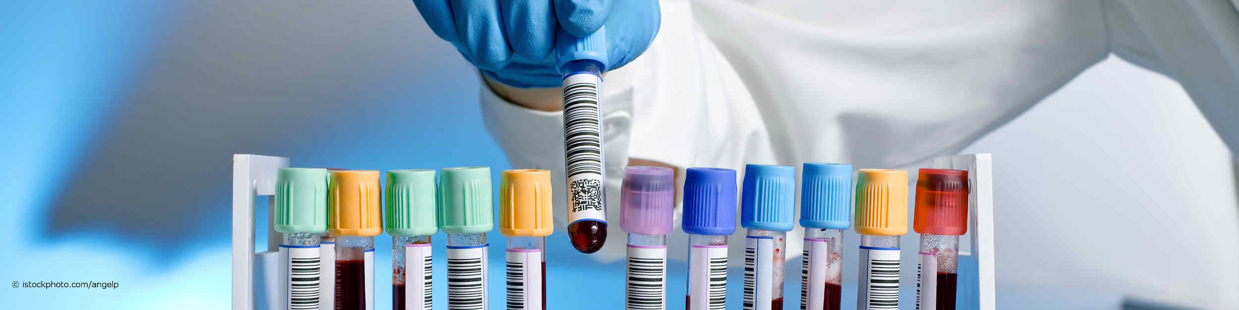 Ein bei DocInsider registrierter Facharzt für Laboratoriumsmedizin fügt ein Röhrchen mit einer Blutprobe und Strich- und Barcodebeschriftung in eine Halterung mit elf anderen Blutproben ein.