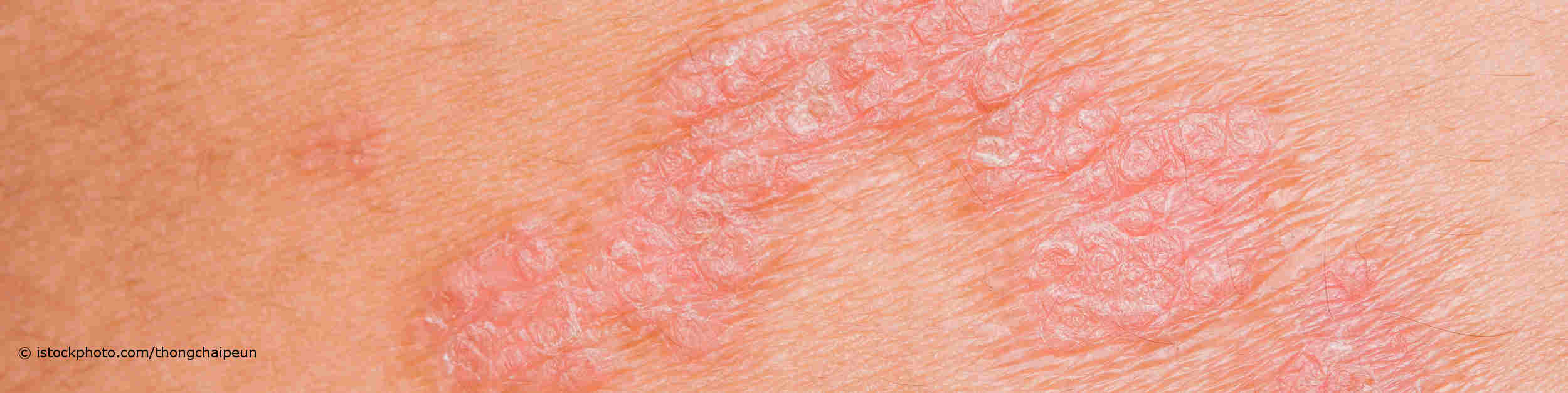 Psoriasis, auch Schuppenflechte genannt, führt zu einer roten und schuppigen Hautentzündung.