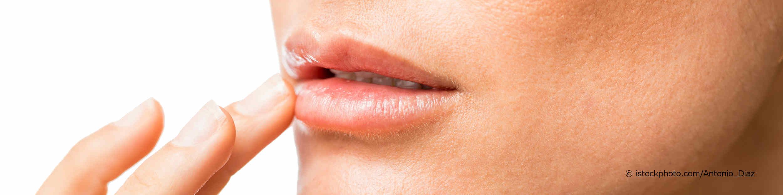 Junge Frau berührt ihren Mund mit Lippenherpes (Herpes simplex).